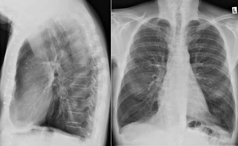 Radiologie Der Lunge Lehrsammlung COPD.